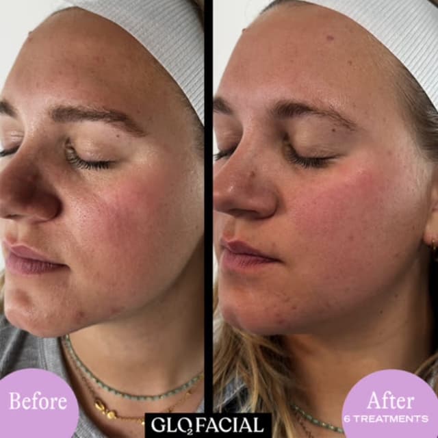RF Pro Skin Tightening Package at Haven Skincare & Aesthetics in Boerne, TX